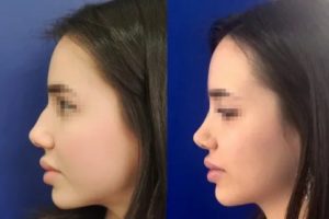 лор операции