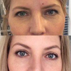 броулифтинг