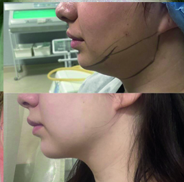 подбородок липосакция