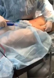 ЛИПОСАКЦИЯ ТЕЛА