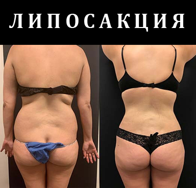 ЛИПОСАКЦИЯ В МЕДИКАЛ ПАРК