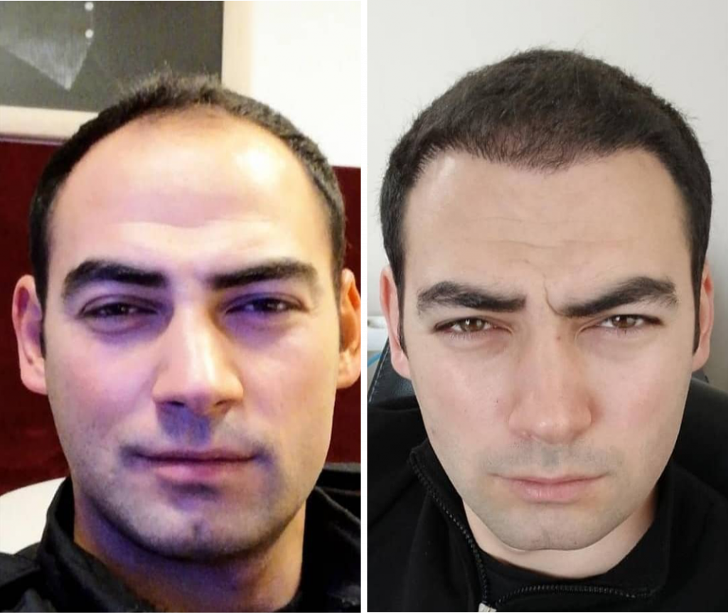 пересадка волос