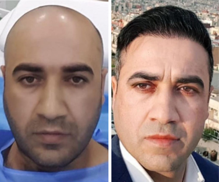 пересадка волос в махачкале