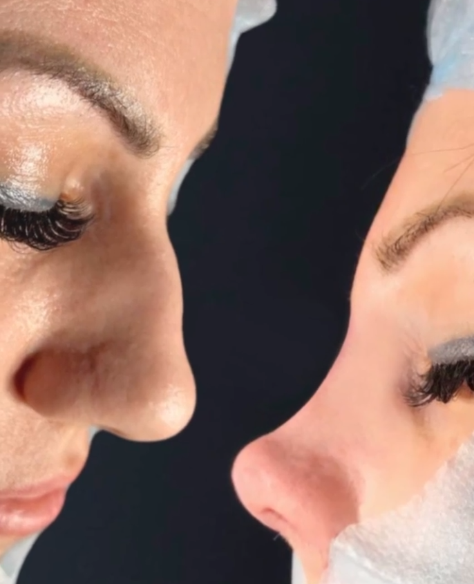 ринопластика до после