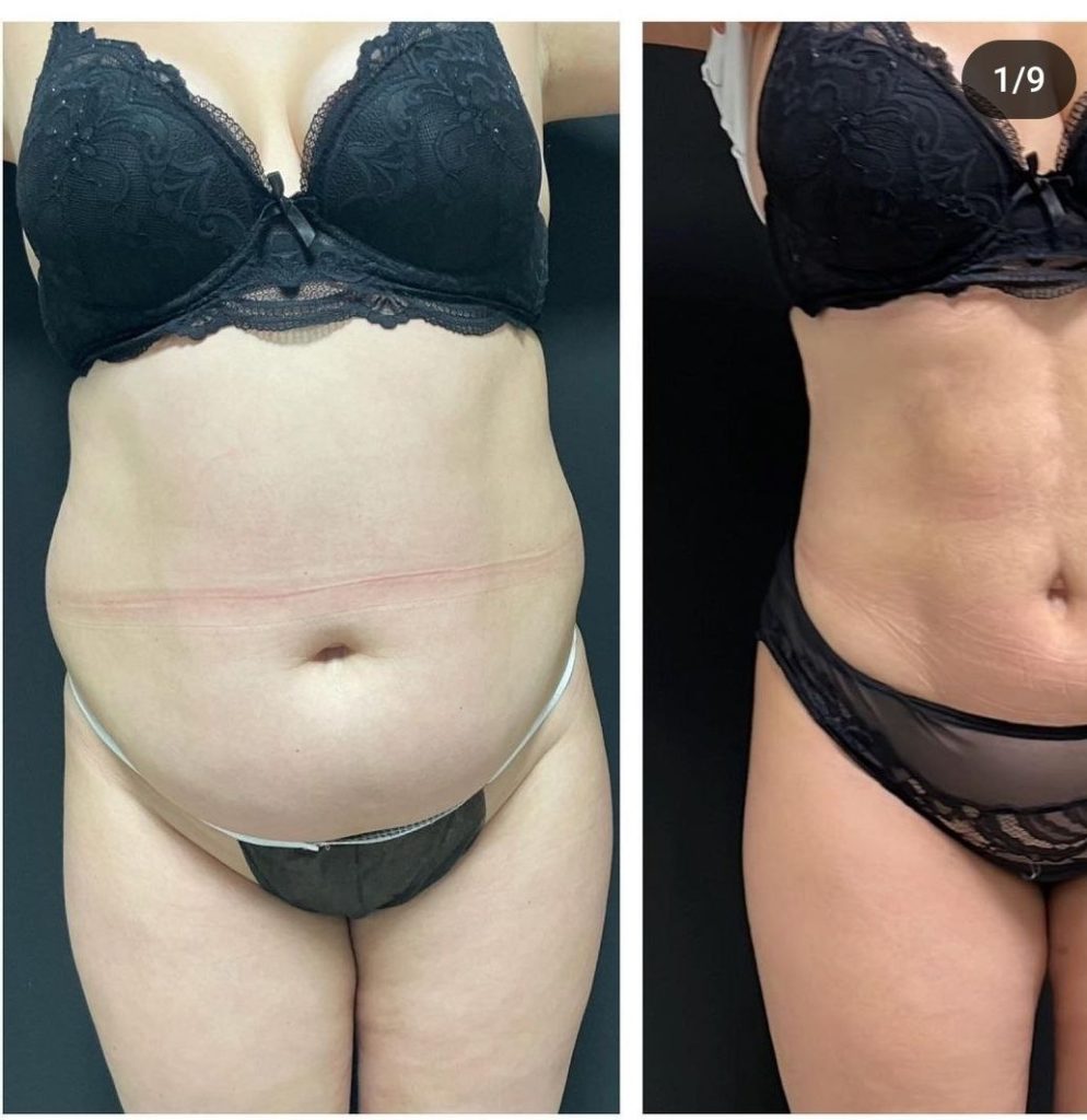 липосакция