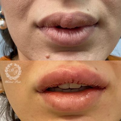 удаление биополимера